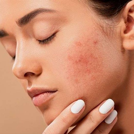 What to do to treat back acne?