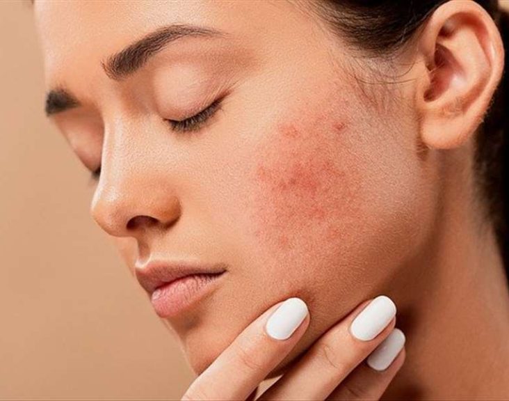 What to do to treat back acne?