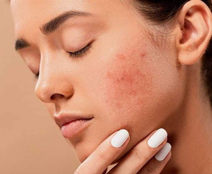 What to do to treat back acne?