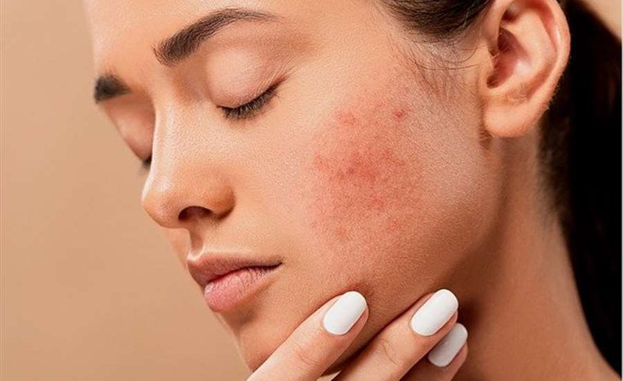 What to do to treat back acne?