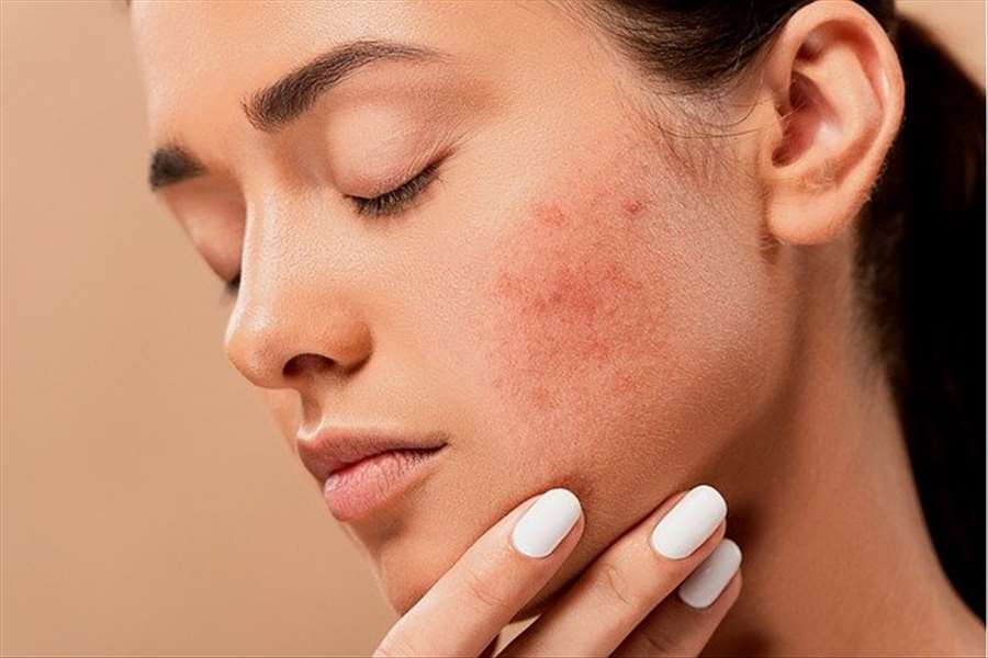 What to do to treat back acne?